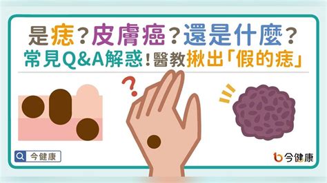 為什麼身上會有痣|是痣？皮膚癌？還是什麼？常見Q&A解惑！醫教揪出「。